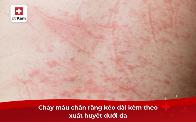 Xuất Huyết Dưới Da