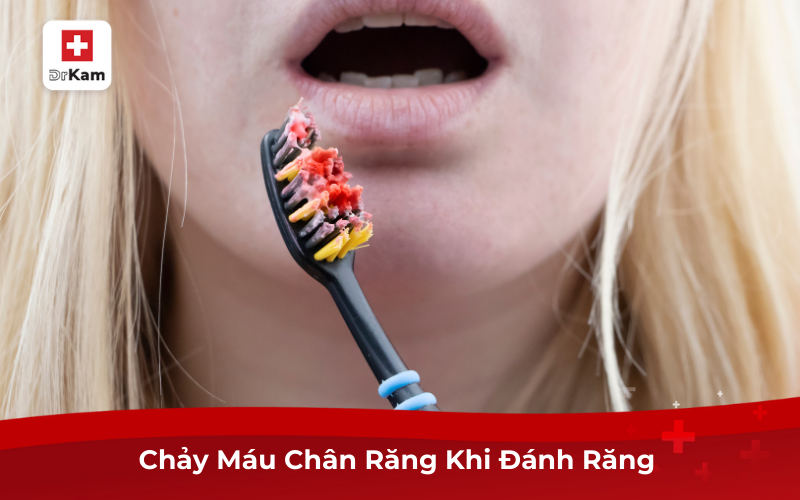 Nguyên Nhân, Cách Điều Trị Chảy Máu Chân Răng Khi Đánh Răng 2 Chảy Máu Chân Răng Khi Đánh Răng