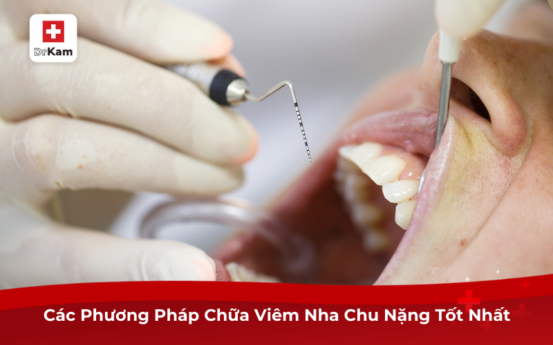 Các Phương Pháp Chữa Viêm Nha Chu Nặng Tốt Nhất