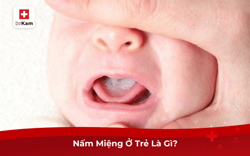 Nấm Miệng Ở Trẻ Là Gì?