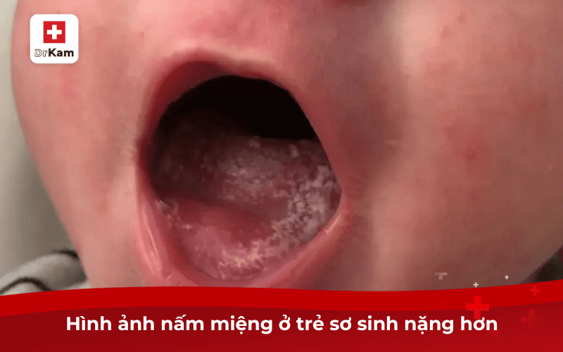 Hình ảnh nấm miệng ở trẻ sơ sinh nặng hơn