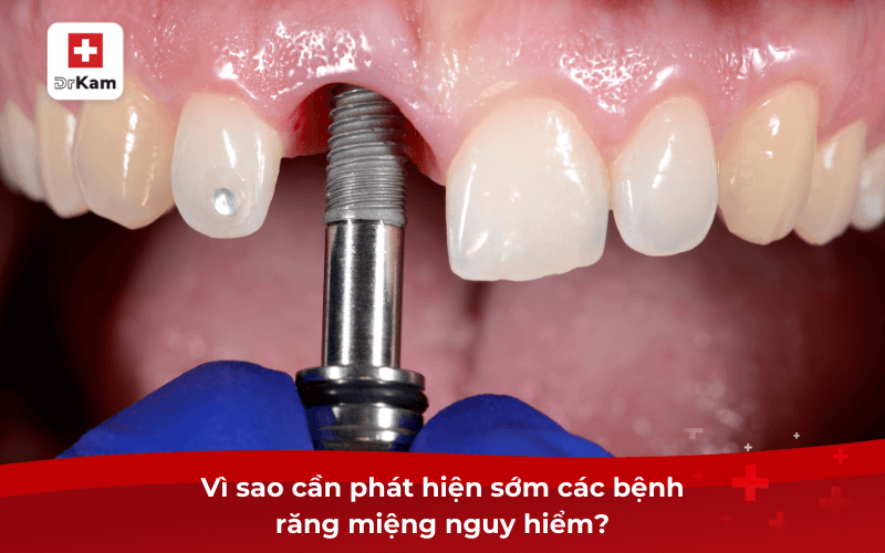 Vì sao cần phát hiện sớm các bệnh răng miệng nguy hiểm?