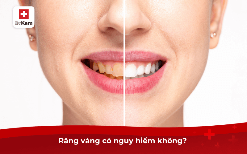 Răng vàng có nguy hiểm không?