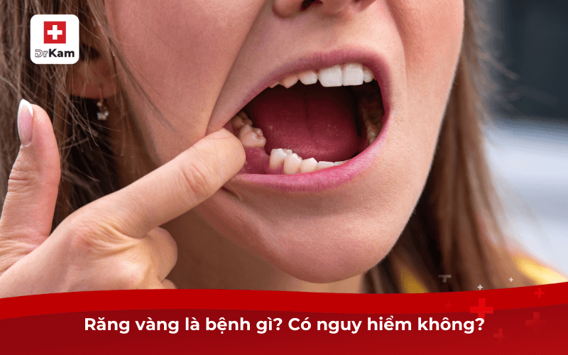 Răng vàng là bệnh gì? Có nguy hiểm không?