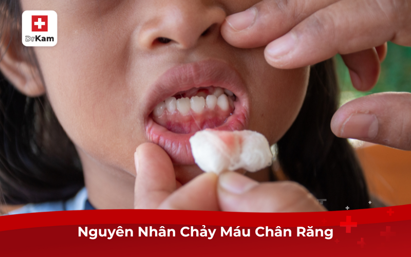 Chảy máu chân răng ung thư: Dấu hiệu không thể xem nhẹ 2 Nguyên nhân chảy máu chân răng
