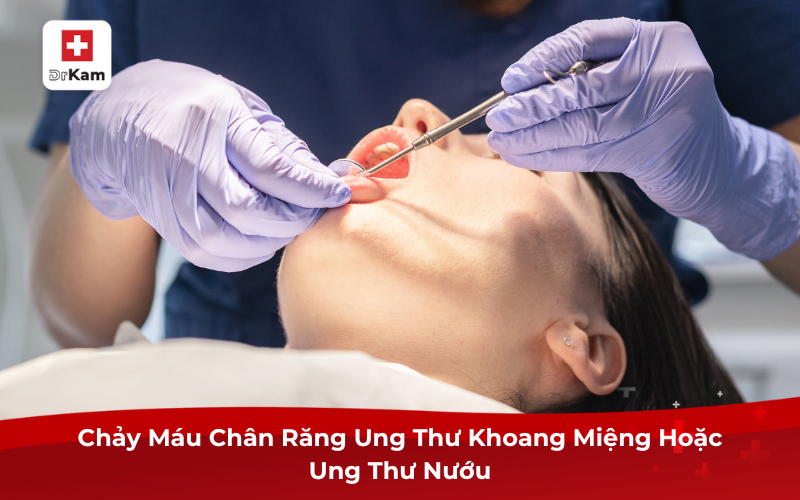 Chảy máu chân răng ung thư: Dấu hiệu không thể xem nhẹ 4 Chảy máu chân răng ung thư khoang miệng hoặc ung thư nướu