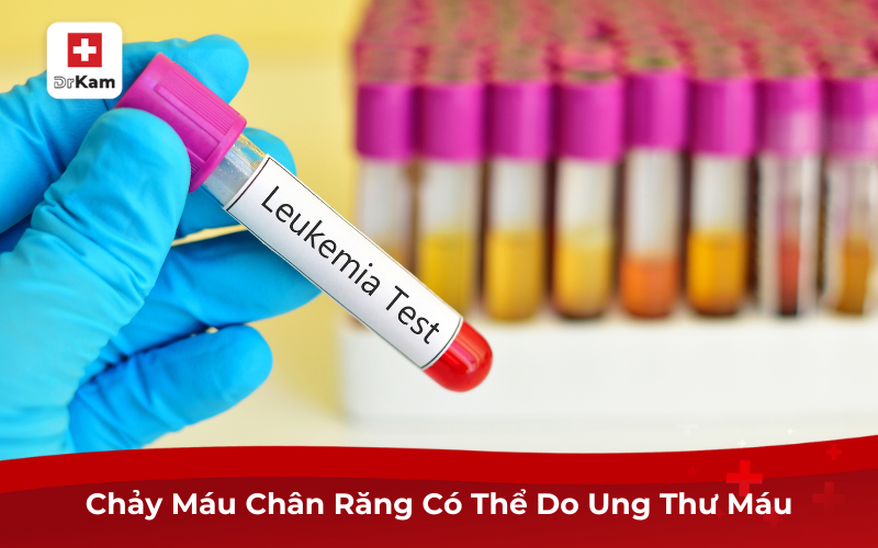 Chảy máu chân răng ung thư: Dấu hiệu không thể xem nhẹ 3 Chảy máu chân răng có thể do ung thư máu
