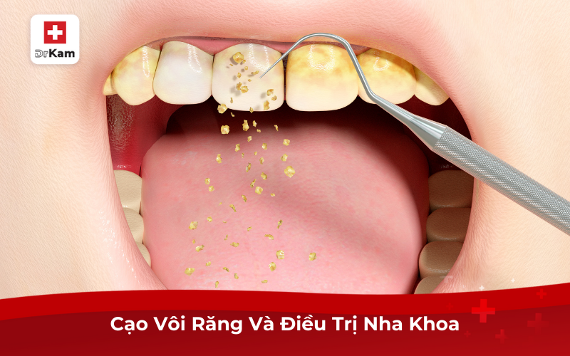 Cách Điều Trị Và Phòng Ngừa Viêm Lợi Chảy Máu Chân Răng 4 Cạo Vôi Răng Và Điều Trị Nha Khoa