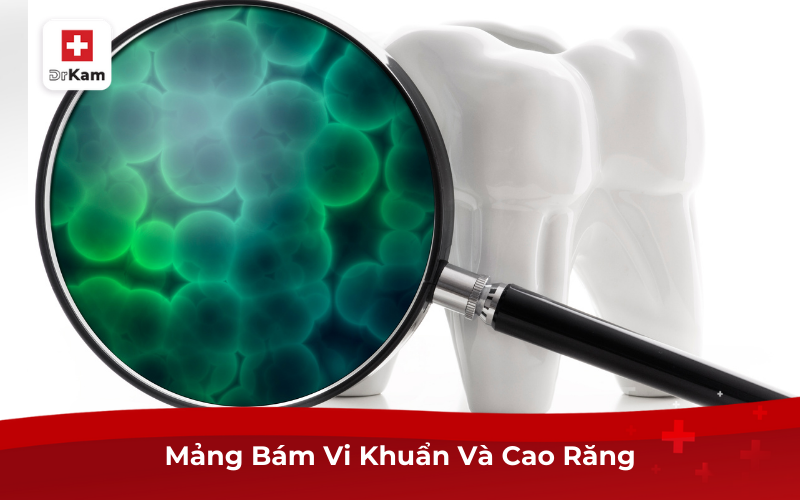 Cách Điều Trị Và Phòng Ngừa Viêm Lợi Chảy Máu Chân Răng 3 Mảng Bám Vi Khuẩn Và Cao Răng