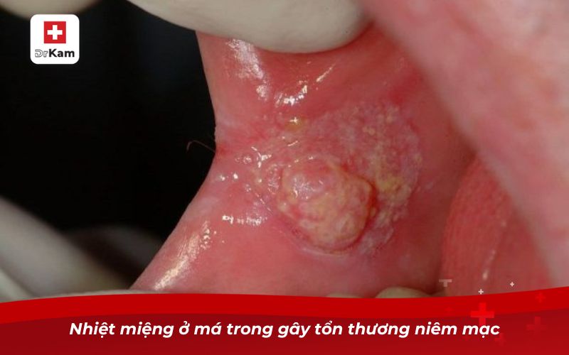 Nhiệt miệng ở má trong gây tổn thương niêm mạc
