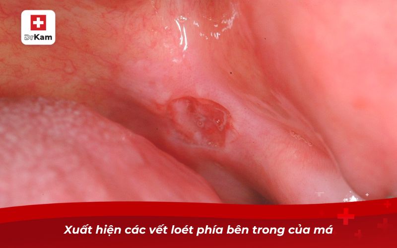 Xuất hiện các vết loét phía bên trong của má