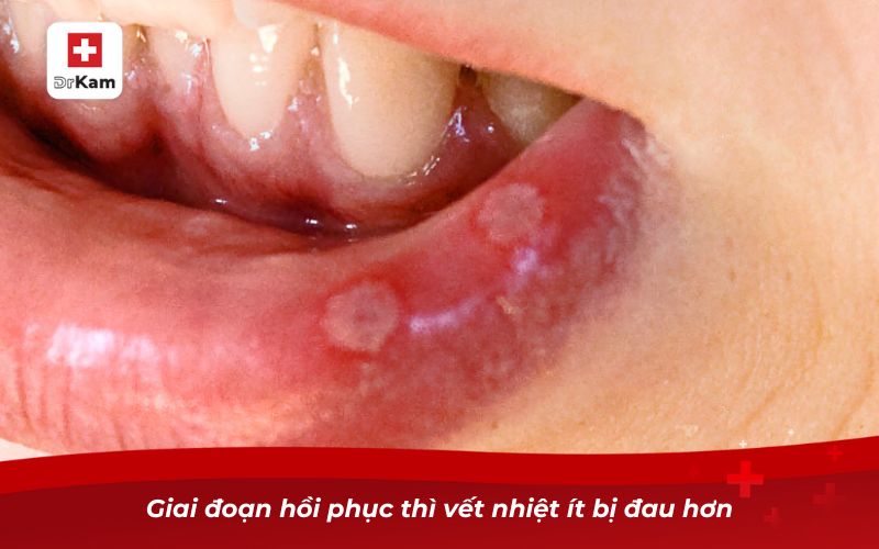 Nhận diện hình ảnh bị nhiệt miệng qua từng giai đoạn 3 Giai đoạn hồi phục thì vết nhiệt ít bị đau hơn