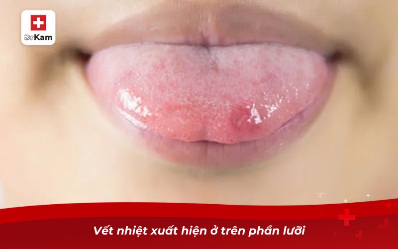 Nhận diện hình ảnh bị nhiệt miệng qua từng giai đoạn 4 Vết nhiệt xuất hiện ở trên phần lưỡi
