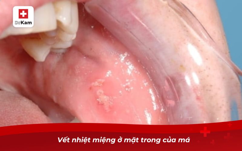 Nhận diện hình ảnh bị nhiệt miệng qua từng giai đoạn 5 Vết nhiệt miệng ở mặt trong của má