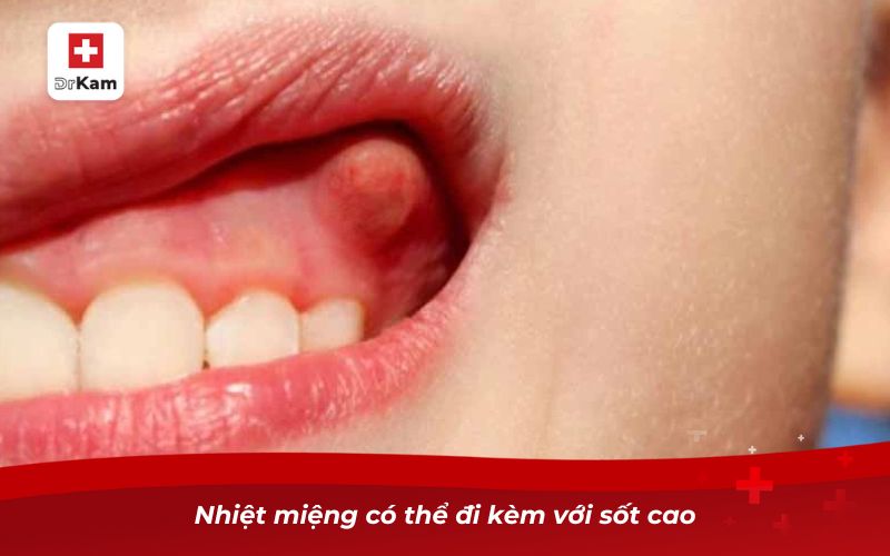 Nhiệt miệng ở lợi - Hiểu đúng để tránh sai lầm khi điều trị 3 Nhiệt miệng có thể đi kèm với sốt cao