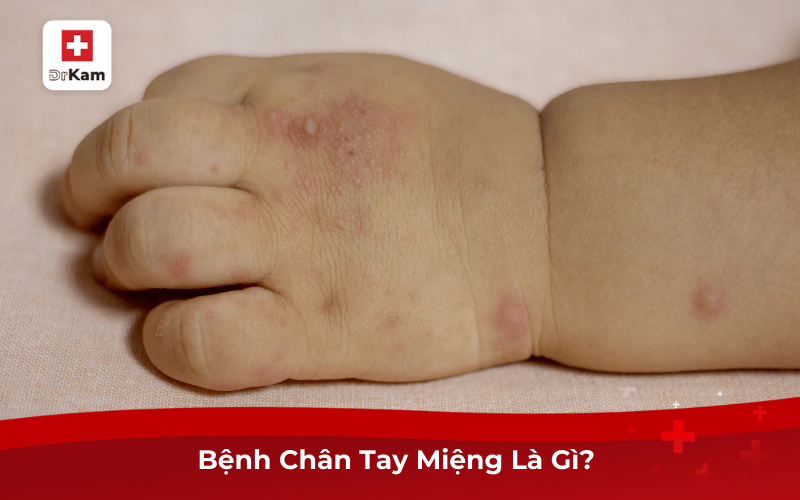 Bệnh Chân Tay Miệng Là Gì?