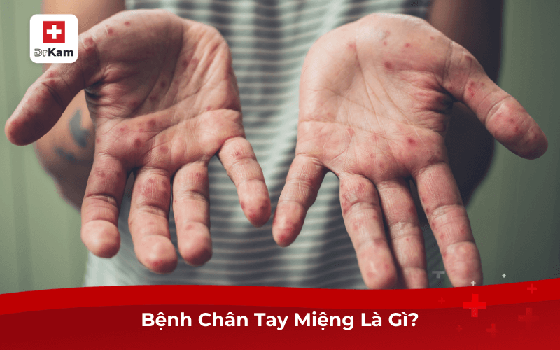 Bệnh Chân Tay Miệng Là Gì?