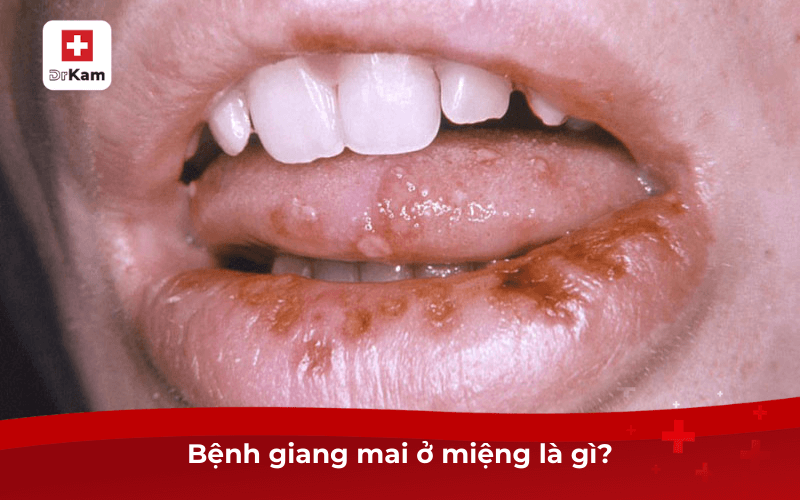 Bệnh giang mai ở miệng là gì?