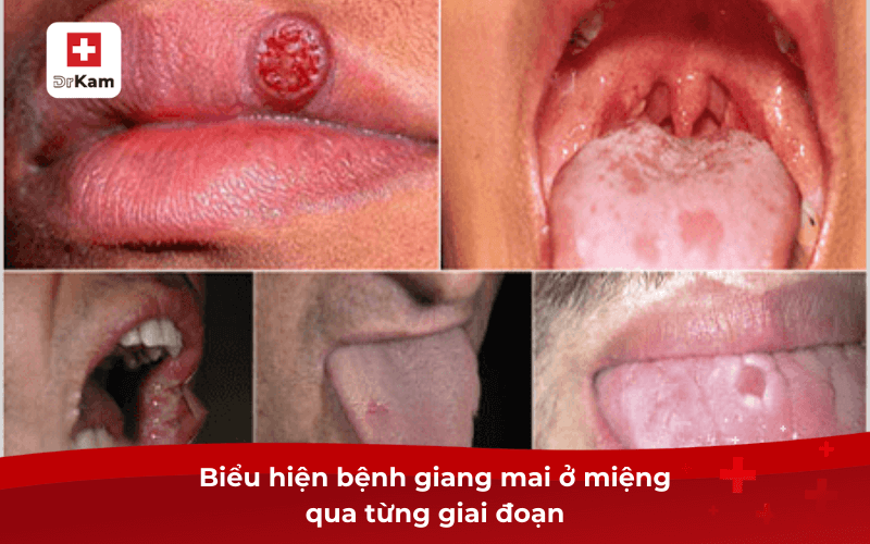 Biểu hiện bệnh giang mai ở miệng qua từng giai đoạn
