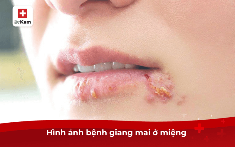 Hình ảnh bệnh giang mai ở miệng 