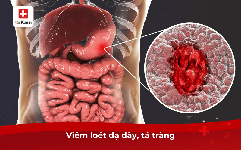 Chua miệng là bệnh gì? Nguyên nhân và cách điều trị 3 Viêm loét dạ dày, tá tràng
