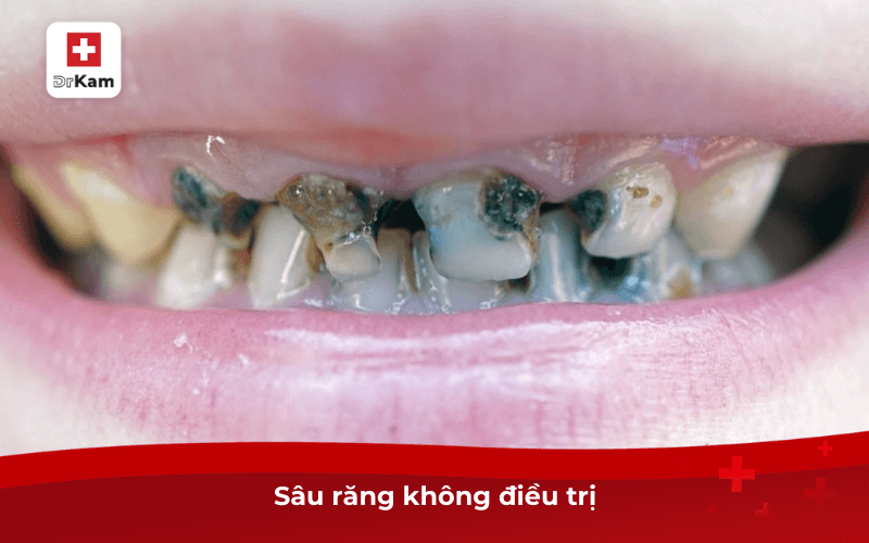 Sâu răng không điều trị