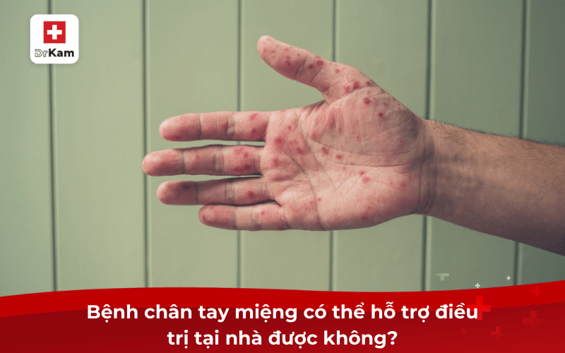 10 mẹo dân gian chữa bệnh chân tay miệng nhanh chóng 2 Bệnh chân tay miệng có thể hỗ trợ điều trị tại nhà được không?