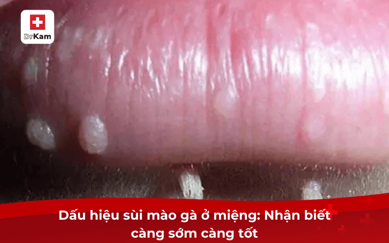 Dấu hiệu sùi mào gà ở miệng: Nhận biết càng sớm càng tốt