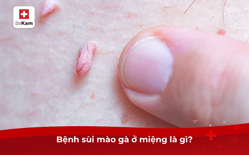 Bệnh sùi mào gà ở miệng là gì?