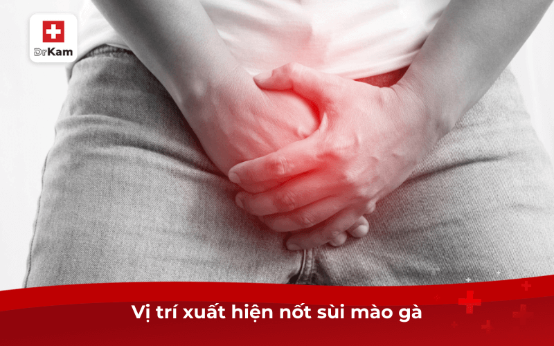 Vị trí xuất hiện nốt sùi