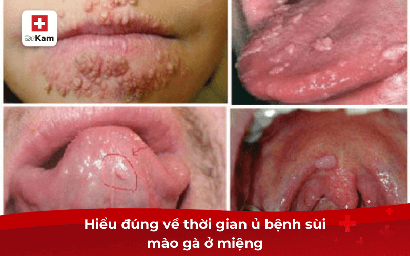 Thời gian ủ bệnh sùi mào gà ở miệng kéo dài bao lâu? 2 Hiểu đúng về thời gian ủ bệnh sùi mào gà ở miệng