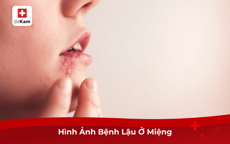 Hình Ảnh Bệnh Lậu Ở Miệng