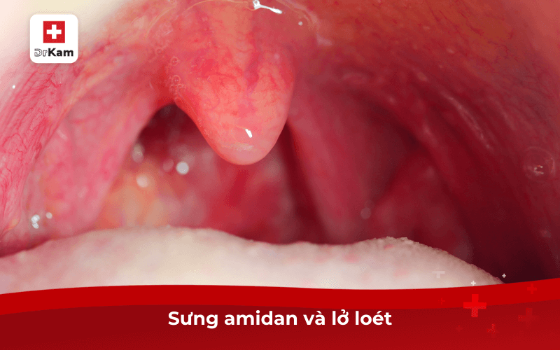 Sưng amidan và lở loét