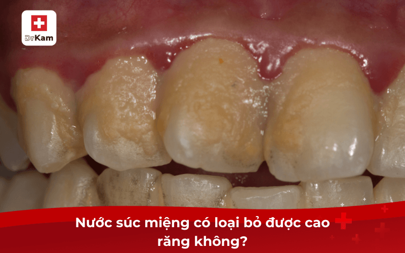 Nước súc miệng có loại bỏ được cao răng không?