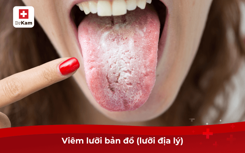 Viêm lưỡi bản đồ (lưỡi địa lý)