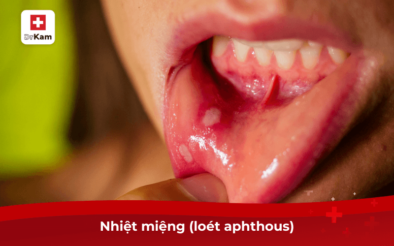 Nhiệt miệng (loét aphthous)