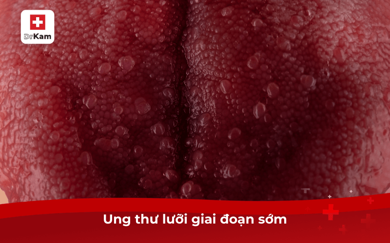Ung thư lưỡi giai đoạn sớm