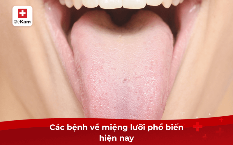 Các bệnh về miệng lưỡi phổ biến hiện nay