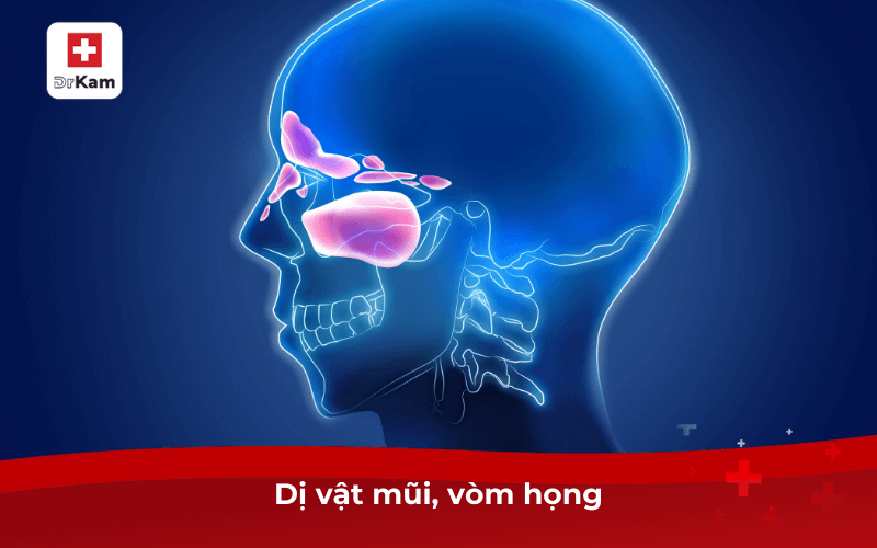 Dị vật mũi, vòm họng