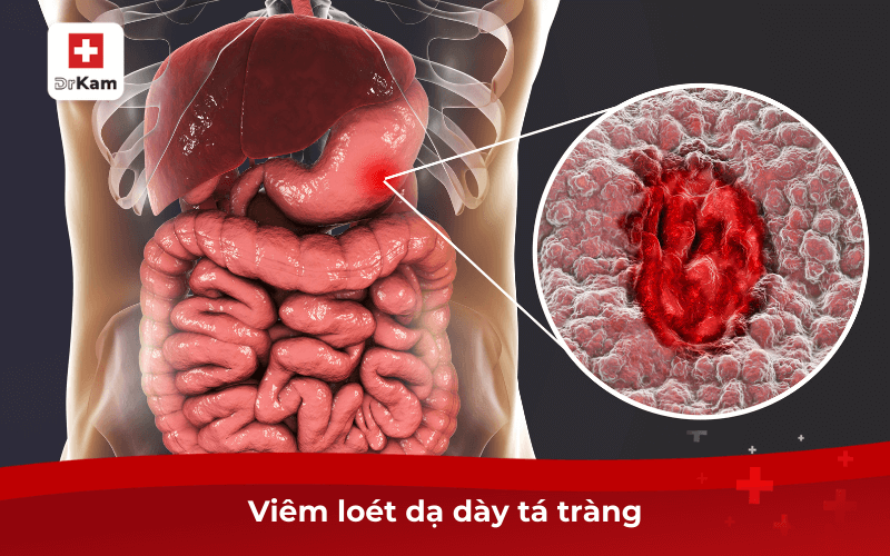 Viêm loét dạ dày tá tràng