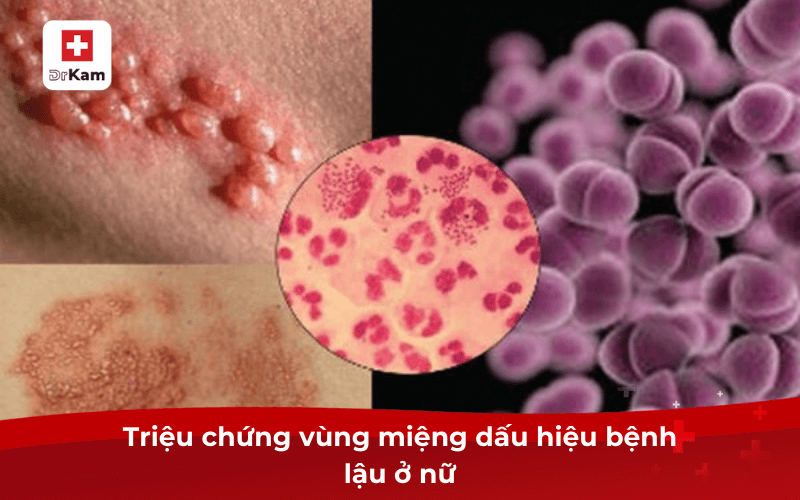 Triệu chứng vùng miệng dấu hiệu bệnh lậu ở nữ