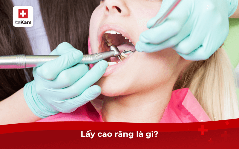 Lấy cao răng là gì?