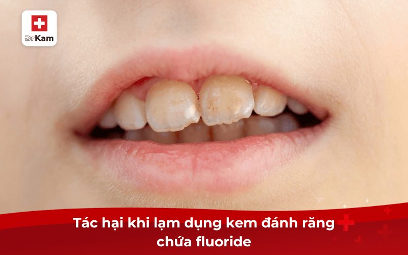 Tác hại khi lạm dụng kem đánh răng chứa fluoride