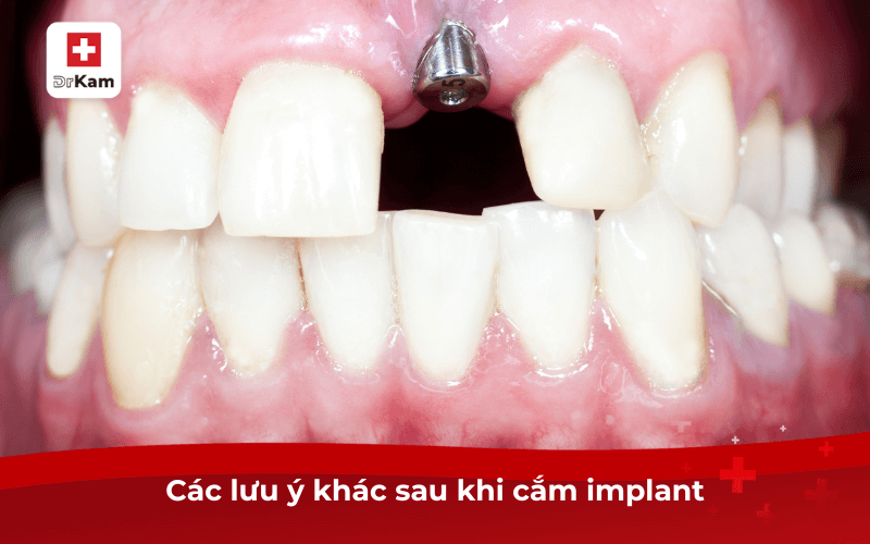 Các lưu ý khác sau khi cắm implant