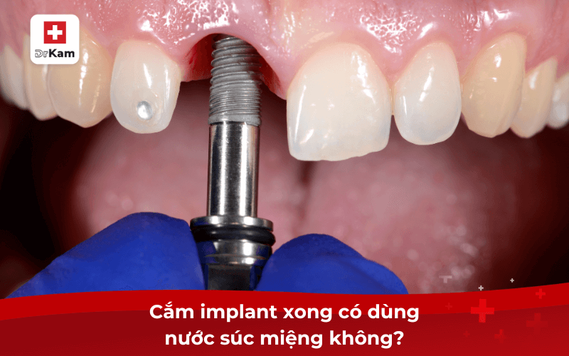 Cắm implant xong có dùng nước súc miệng không?