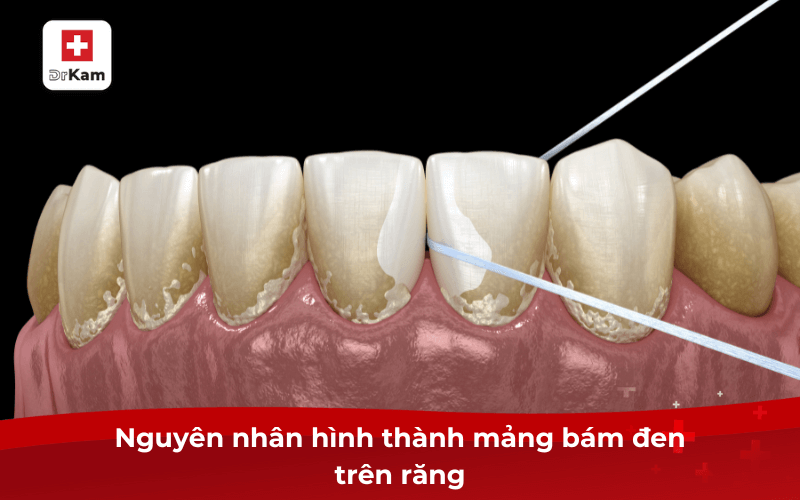 Mảng bám đen trên răng - 7 cách làm sạch hiệu quả ngay lập tức 3 Nguyên nhân hình thành mảng bám đen trên răng