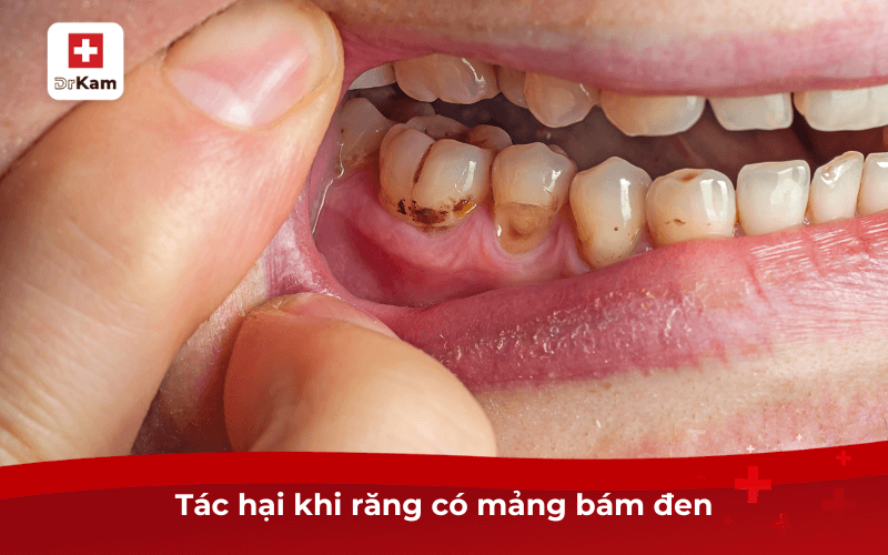 Mảng bám đen trên răng - 7 cách làm sạch hiệu quả ngay lập tức 4 Tác hại khi răng có mảng bám đen