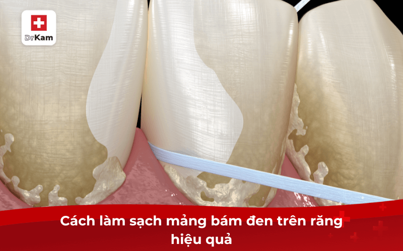 Mảng bám đen trên răng - 7 cách làm sạch hiệu quả ngay lập tức 5 Cách làm sạch mảng bám đen trên răng hiệu quả