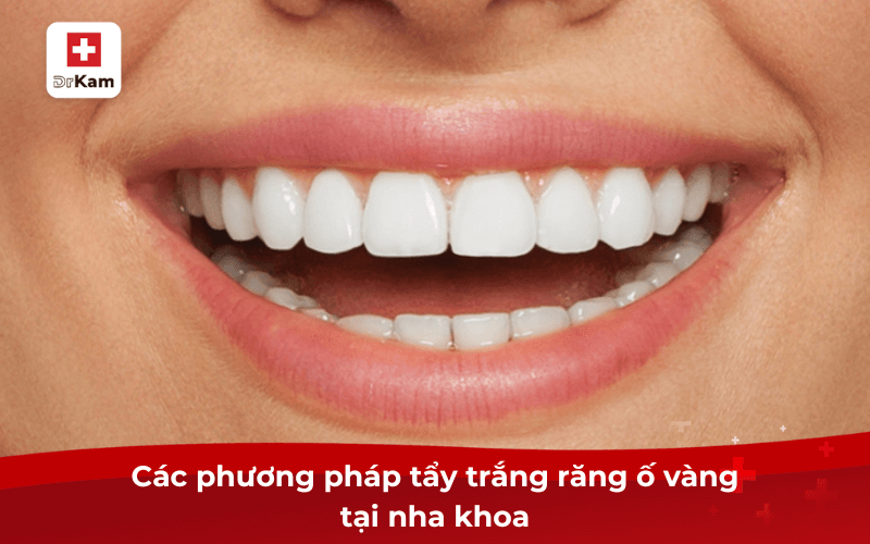 20 Cách tẩy trắng răng ố vàng an toàn hiệu quả nhất hiện nay 4 Các phương pháp tẩy trắng răng ố vàng tại nha khoa
