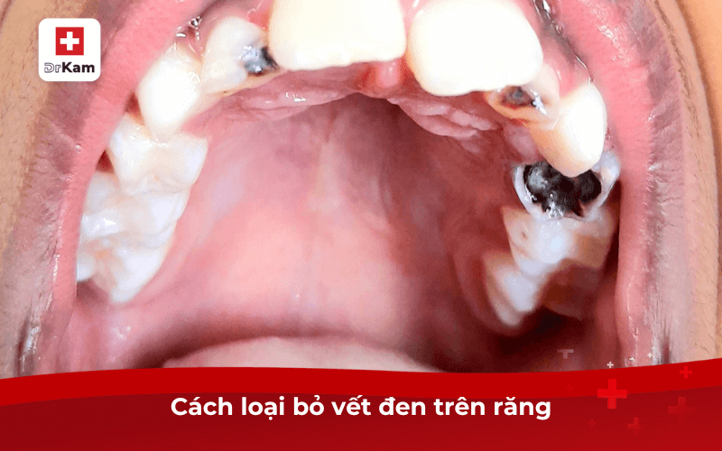 Răng có vết đen: Nguyên nhân, tác hại và 8 cách loại bỏ vết đen răng hiệu quả ngay 4 Cách loại bỏ răng có vết đen